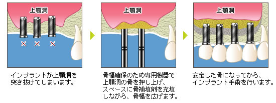 サイナスリフト